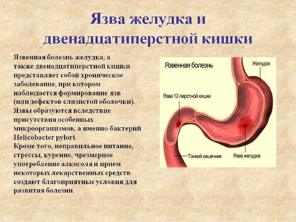 Язва желудка симптомы и гастрит симптомы