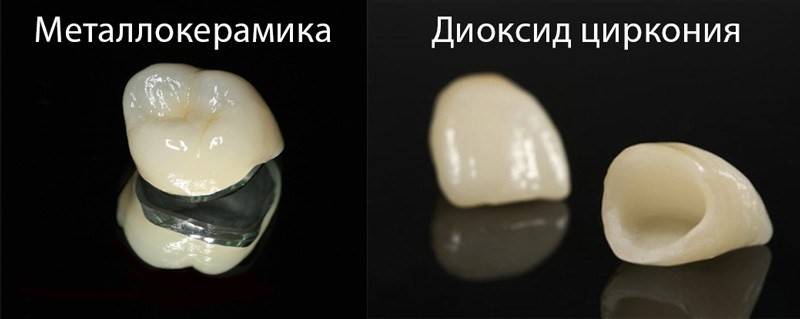 Виды металлокерамики. чем отличаются и почему