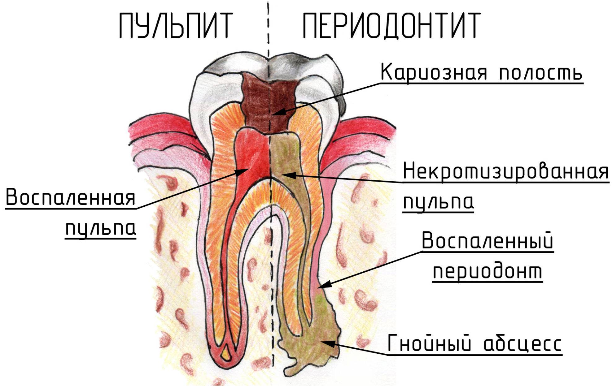 Кариес, периодонтит, пульпит: что такое, чем отличаются, как определить