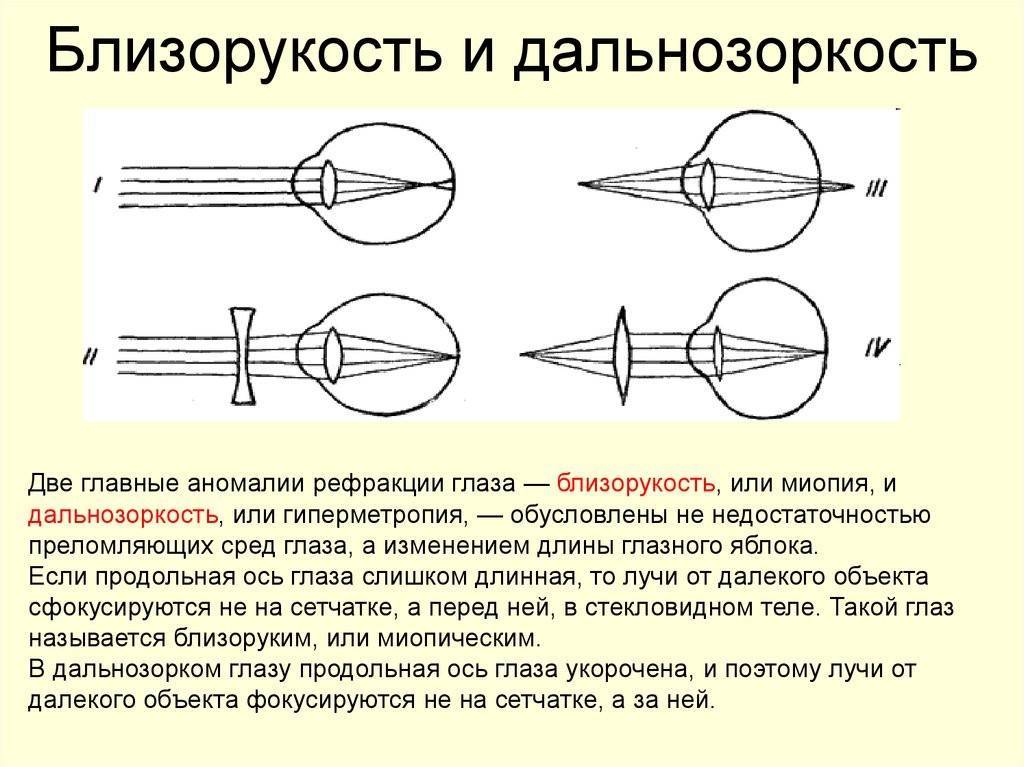 Близорукость и дальнозоркость простыми словами (7 фактов)
