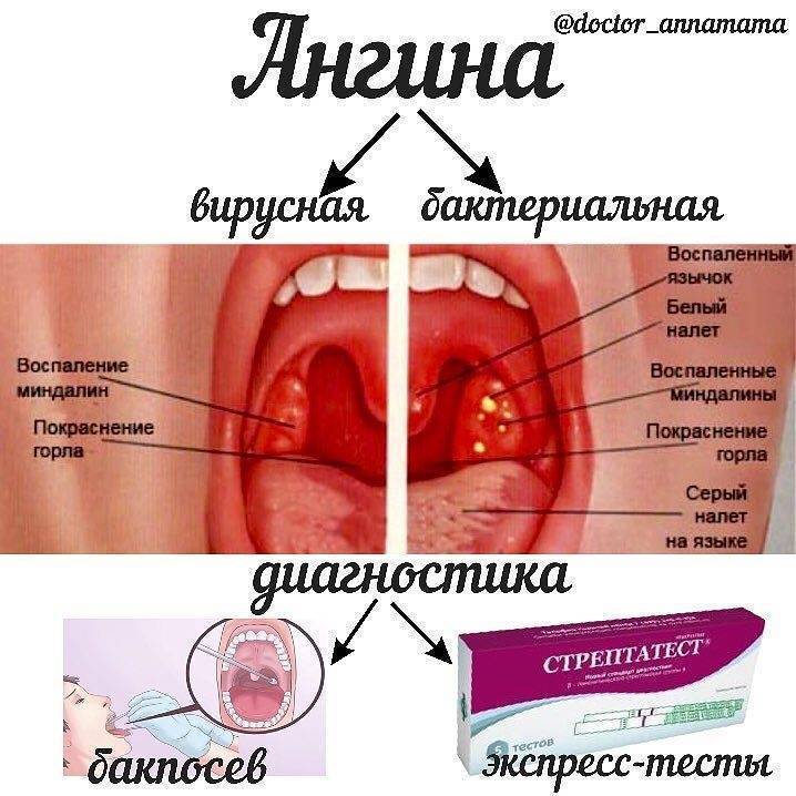 Разница между ангиной и тонзиллитом