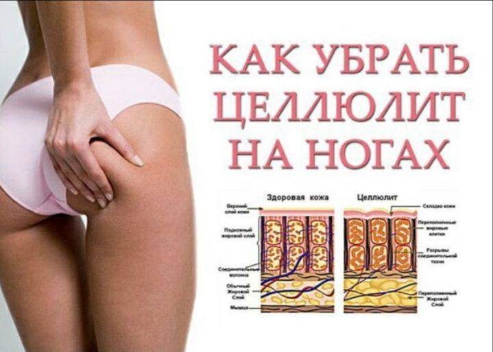 Как избавиться от целлюлита на попе — различные способы и методы лечения апельсиновой корки, правильное питание