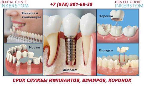 Что лучше коронка или имплант: сравнение, плюсы и минусы | za-rozhdenie.ru