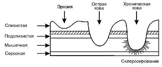Хронический гастрит и дуоденит, гастродуоденит: диагностика и лечение