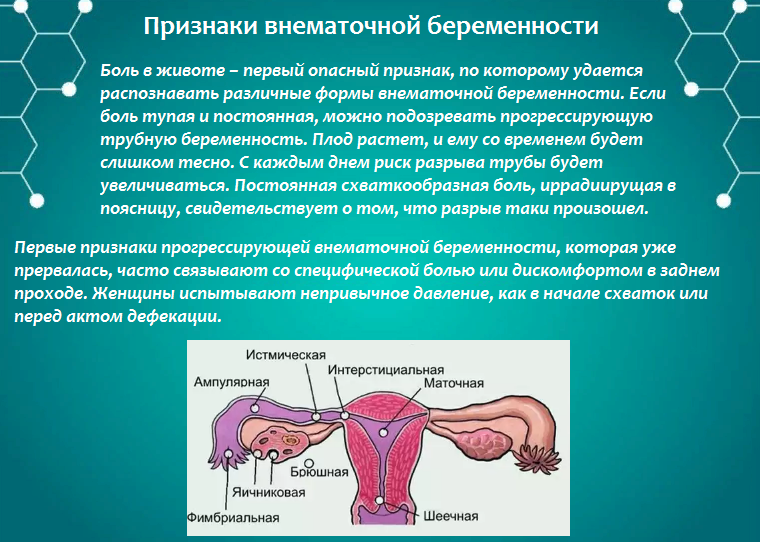 Внематочная беременность - признаки, располагающие факторы
