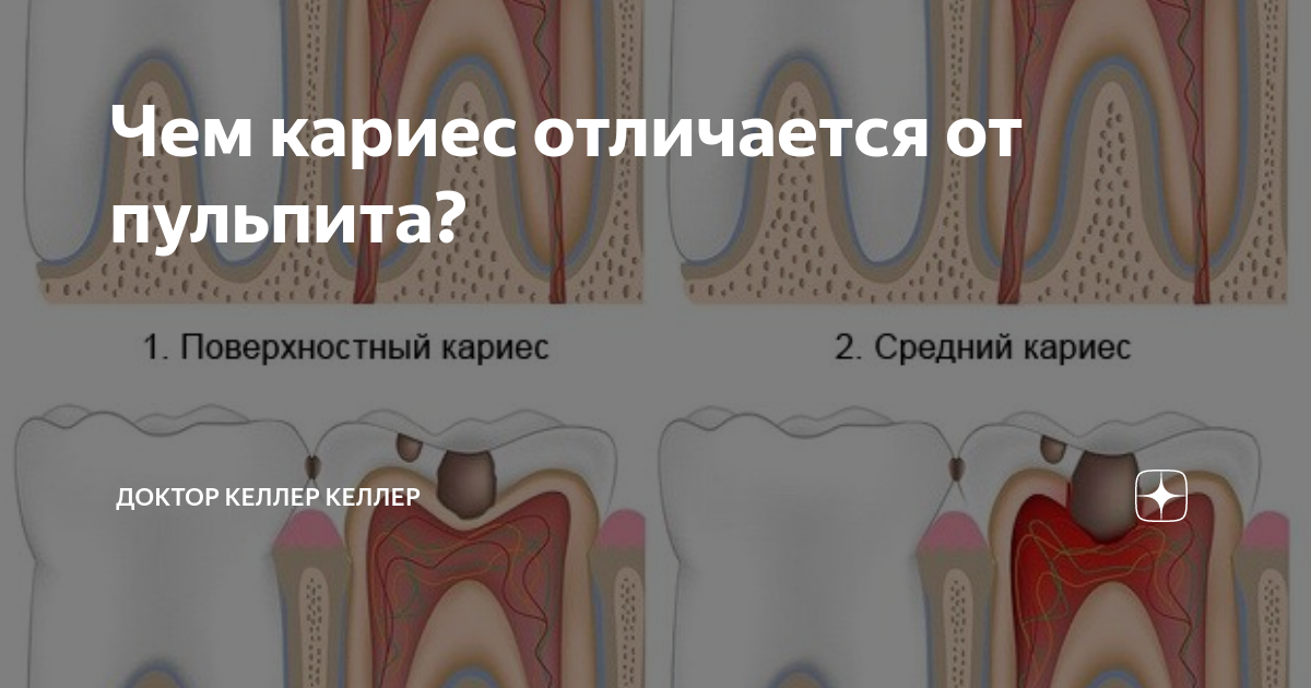 Чем отличается пульпит от кариеса | диагностика