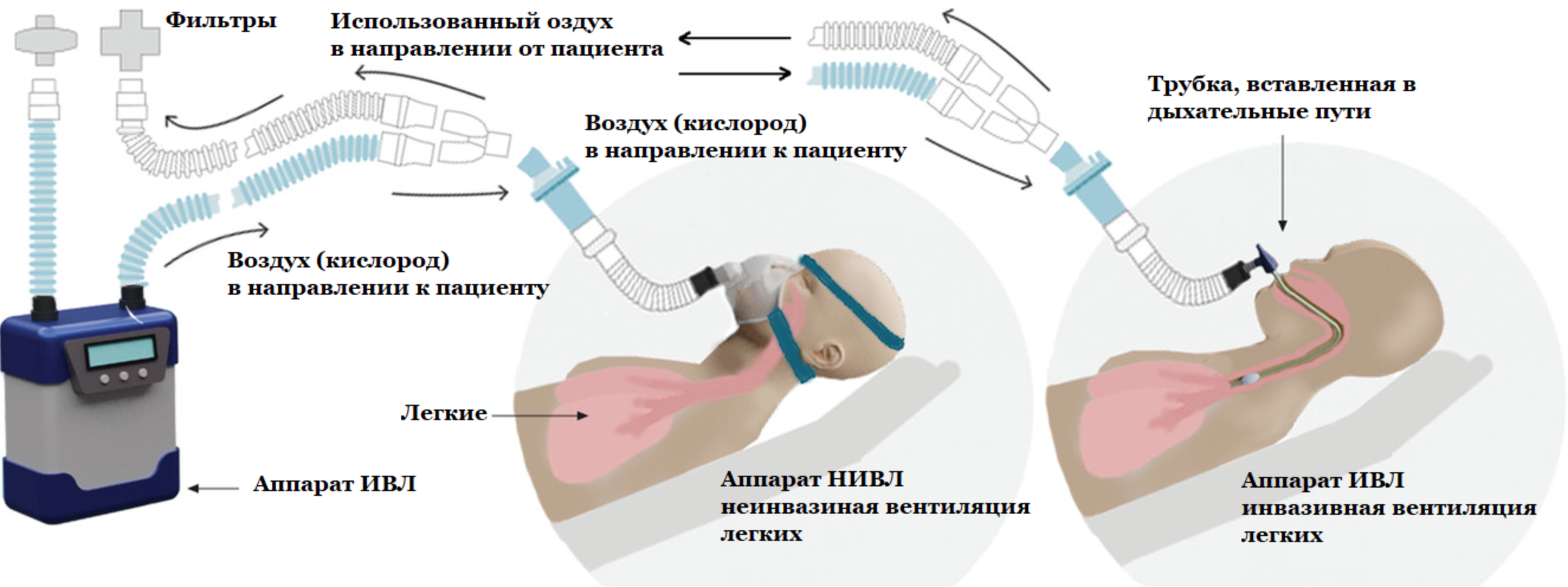 Вентиляция легких после операции. Эндотрахеальная трубка для аппарата ИВЛ. Типы аппаратов ИВЛ.