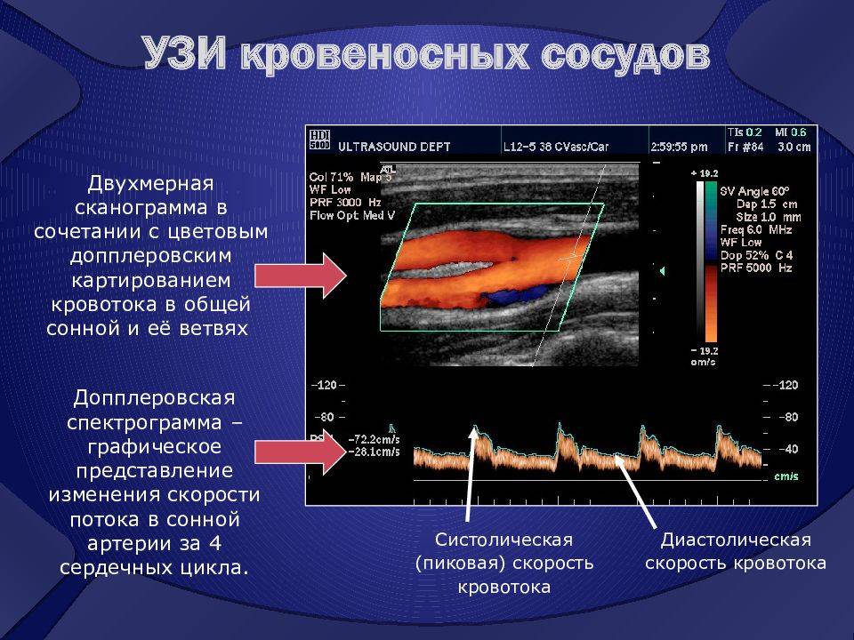 Допплерография или дуплексное сканирование, что лучше и в чем разница между уздг и уздс