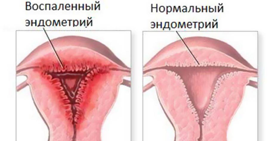 Эндометрит у женщин: 8 причин, 3 варианта лечения, послеродовой