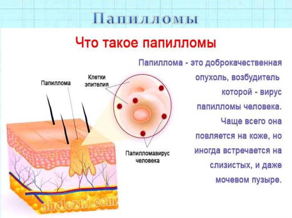 Основные отличия родинки от папилломы