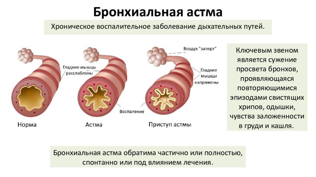 Отличие астмы от бронхита: характерные симптомы